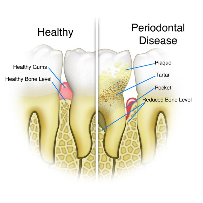 Periodontal Treatment - Dental Services